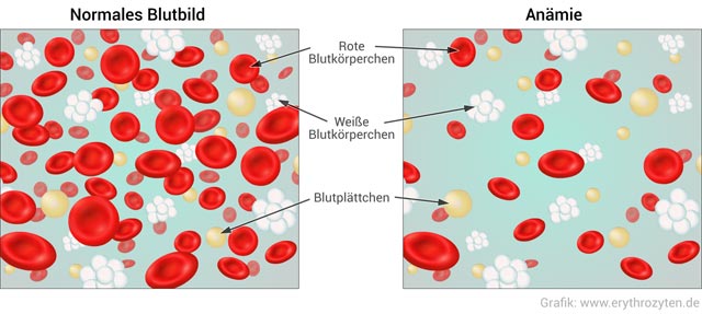 Anämie (Blutmangel): zu wenig Hämoglobin
