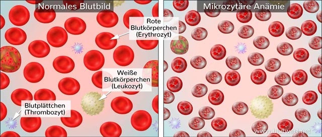 Mikrozytäre Anämie