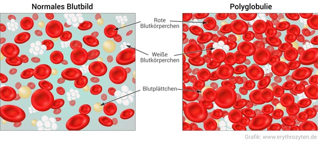 Polyglobulie