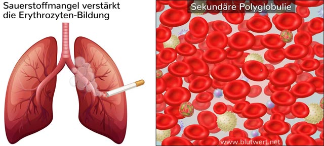 Sekundäre Polyglobulie