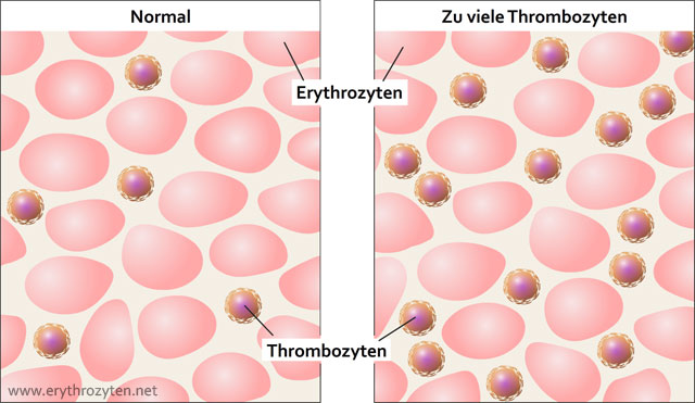 Thrombozyten Zu Hoch Was Tun www.erythrozyten.net