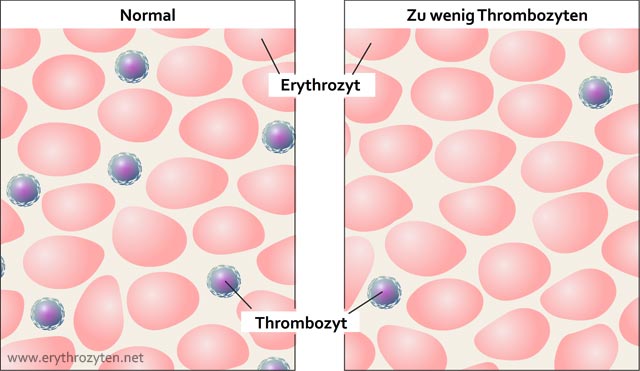 Thrombozyten Zu Niedrig Schwangerschaft Erfahrungen www.erythrozyten.net